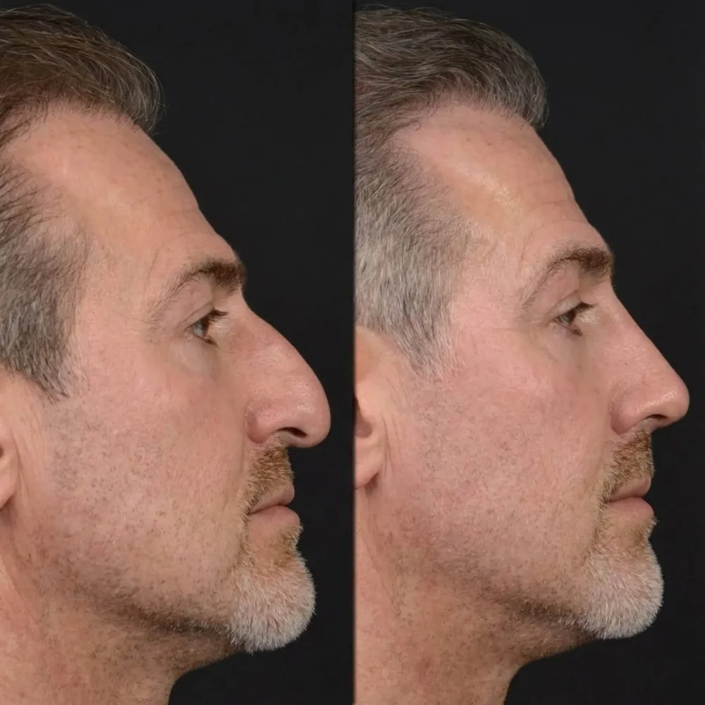 Nose Surgery Price Guide 2025: Turkey vs US/UK Cost Analysis