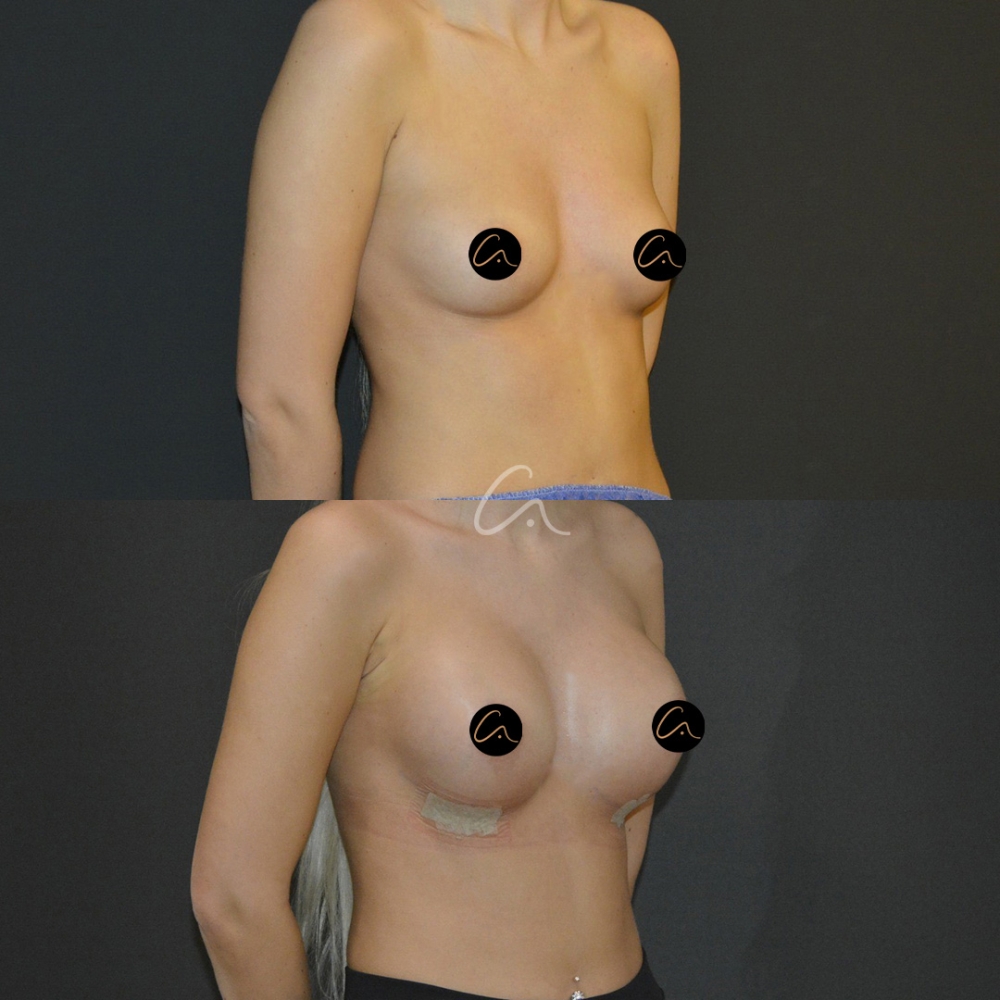 Forehead Tightening Plastic Surgery in Istanbul/Turkey