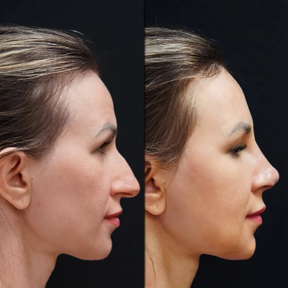 Nose Surgery Price Guide 2025: Turkey vs US/UK Cost Analysis