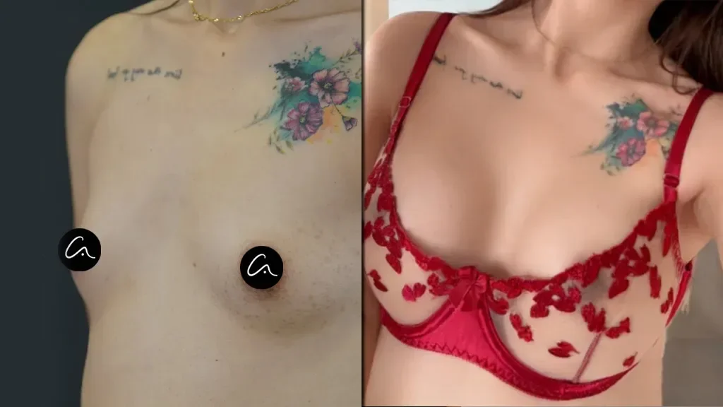 Ballerina Breast Augmentation: Natural Elegance for Petite Frames