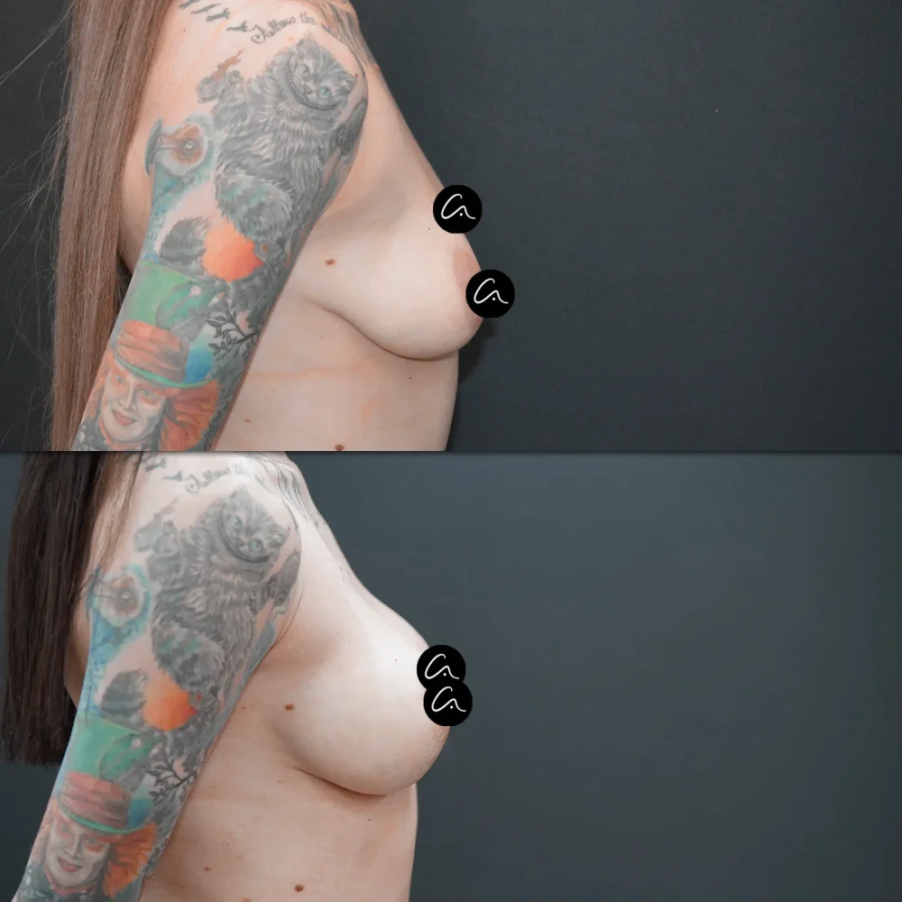 Was ist eine Piezo-Rhinoplastik? Vorteile, Genesungsprozess und häufig gestellte Fragen