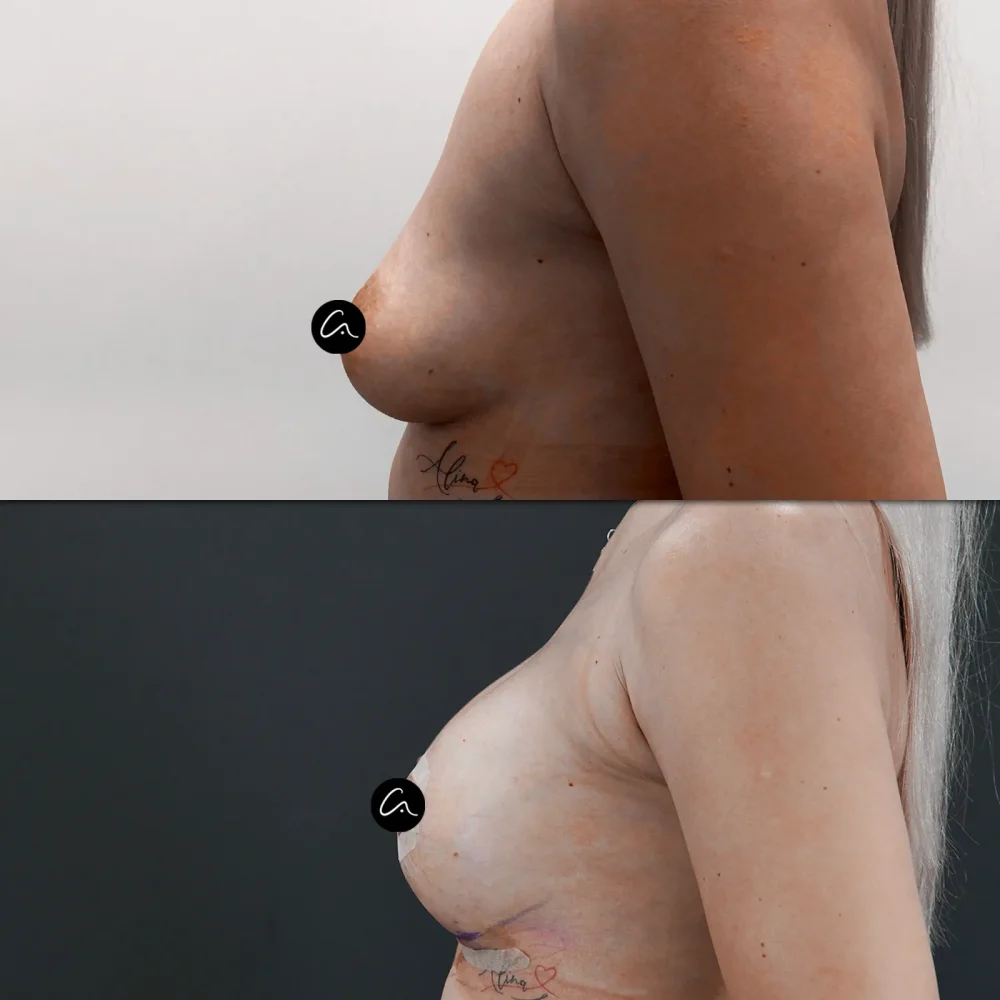 What is Piezo Rhinoplasty? Advantages, Recovery Process and Frequently Asked Questions