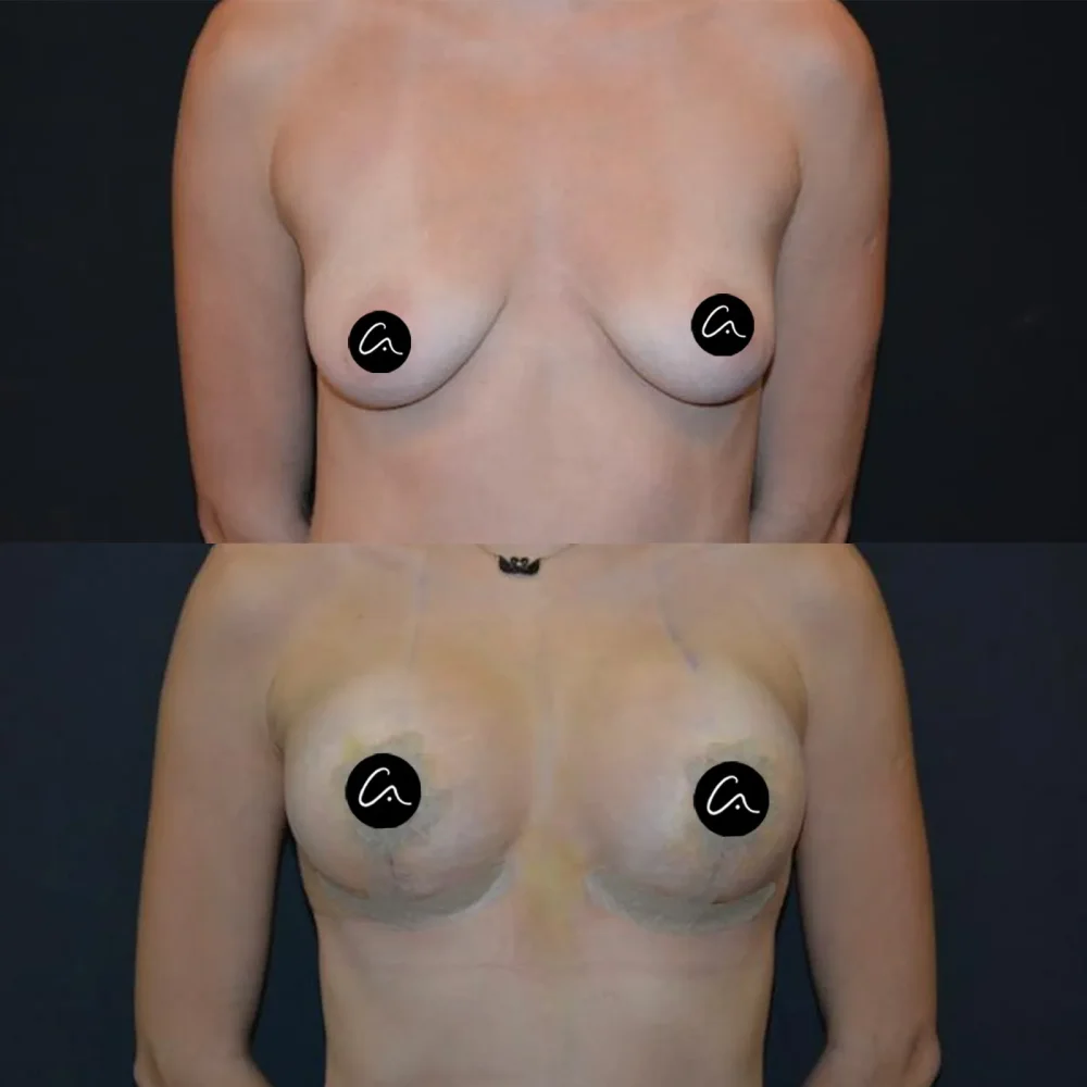 ¿Qué es la rinoplastia piezoeléctrica? Ventajas, proceso de recuperación y preguntas frecuentes