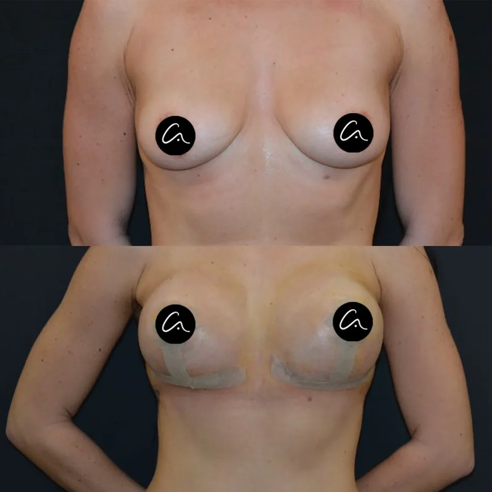 What is Piezo Rhinoplasty? Advantages, Recovery Process and Frequently Asked Questions