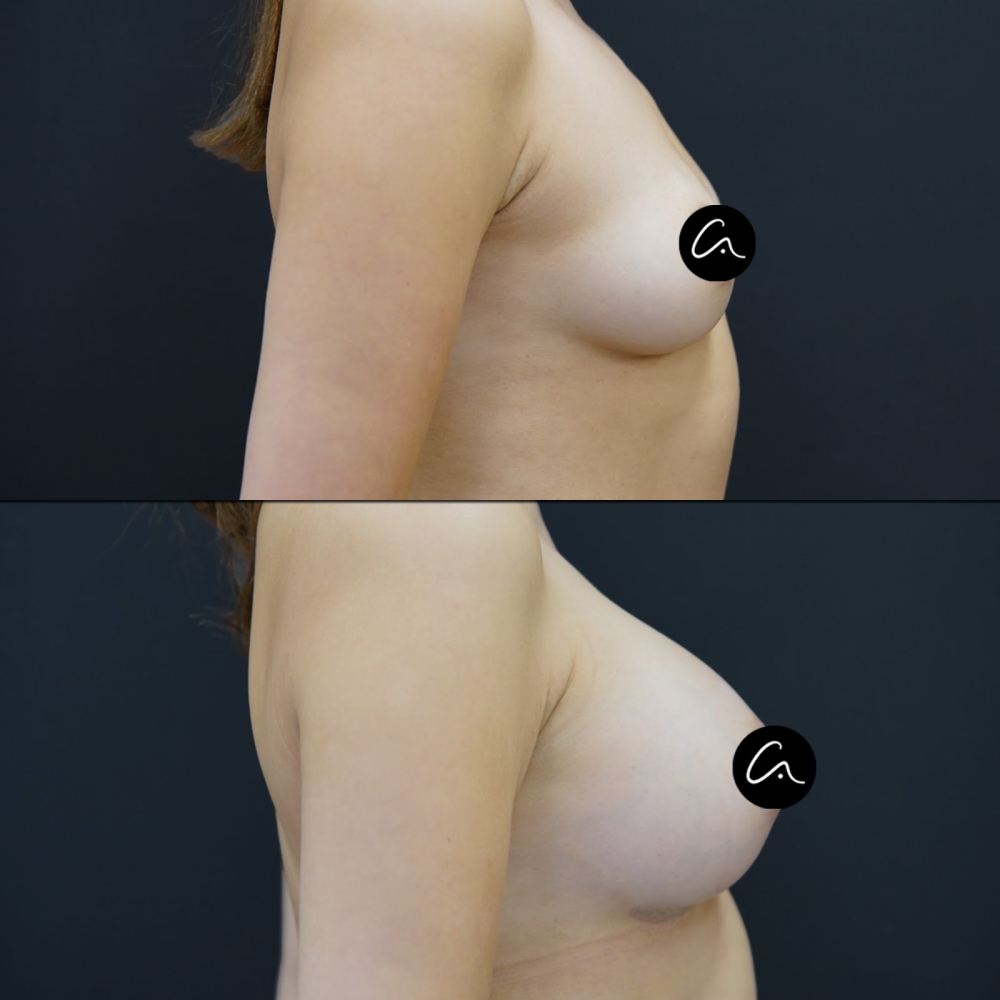 Forehead Tightening Plastic Surgery in Istanbul/Turkey