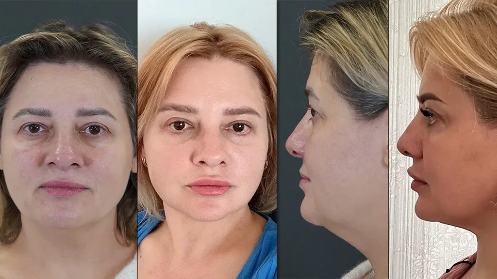 What Age Is the Right Age for a Facelift? A Plastic Surgeon's Honest Guide