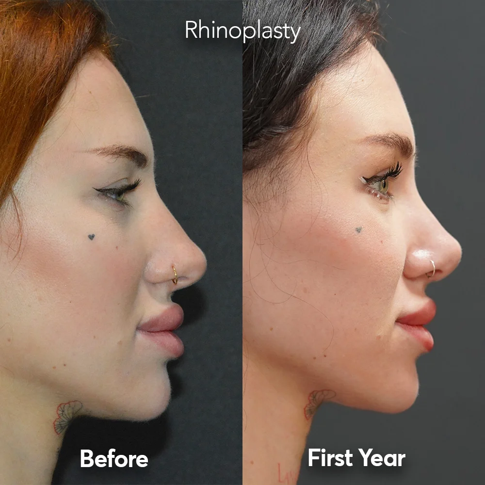 Most Preferred Plastic Surgeries by Age