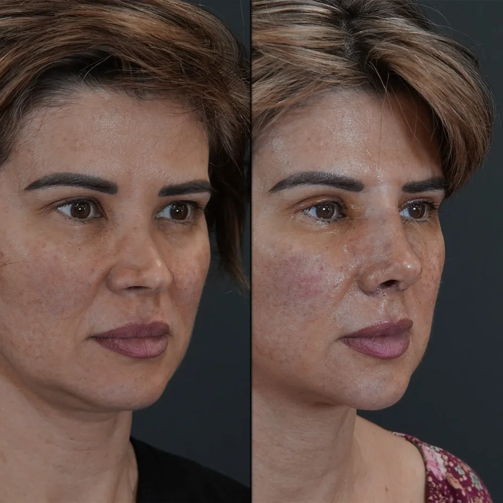 Plastic Surgery Prices in Turkey 2025: Comprehensive Guide for International Patients