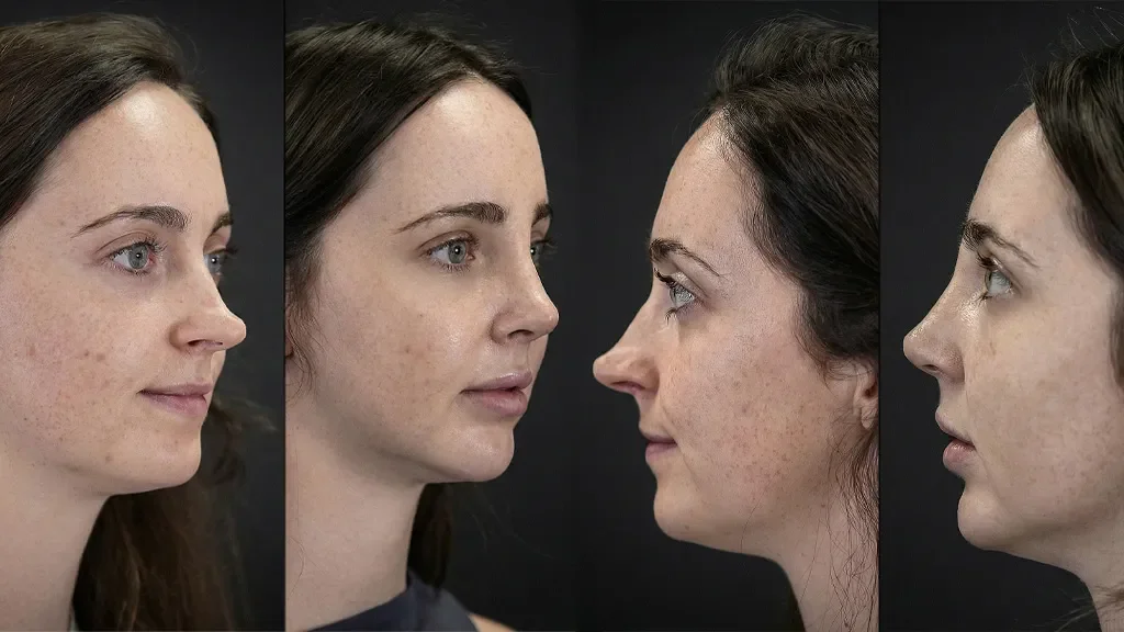 Best Revision Rhinoplasty Surgeon in Turkey | Dr. Celal Alioglu