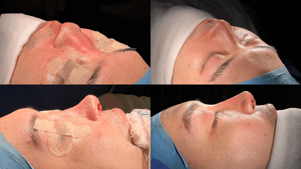 The Role of Cartilage Grafts in Revision Rhinoplasty: Ear, Rib, or Septum?